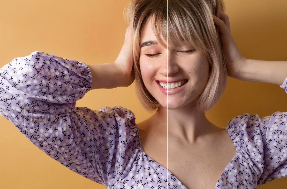 endolift antes y después