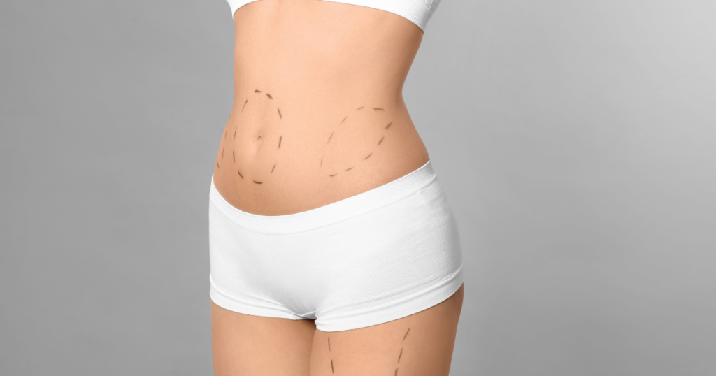 Diferencia entre liposucción y lipoescultura
