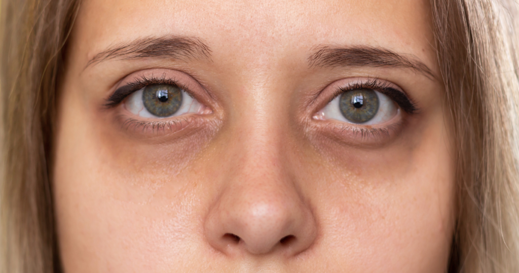 Mejores tratamientos para ojeras hundidas